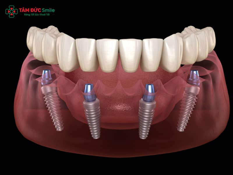 1. Đặc điểm nổi bật của Implant Pháp 1.1 Chất liệu titanium nguyên chất – an toàn sinh học Trụ Implant Pháp được sản xuất từ titanium tinh khiết hoặc hợp kim titanium y sinh – vật liệu đã được chứng minh có tính tương thích sinh học cao nhất hiện nay. Nhờ đó, khi Abc8vip1 kèo WC 2026 vào ABC8 tự hào là thương hiệu cá cược trực tuyến hàng đầu tại Châu Á hiện nay, trụ ít gây phản ứng đào thải, giúp tích hợp xương nhanh và ổn định lâu dài. So với các dòng Implant thông thường, titanium nguyên chất trong Implant Pháp mang lại khả năng chống ăn mòn, chịu lực nhai bền bỉ và duy trì được độ bền trên 20 năm. 1.2 Thiết kế ren tiên tiến, giúp tăng độ ổn định sơ khởi Một trong những đặc trưng của dòng trụ Implant Pháp chính là thiết kế ren kép hoặc ren xoắn sâu, giúp tăng diện tích tiếp xúc giữa trụ và xương. Nhờ đó, Implant Pháp đạt được độ ổn định sơ khởi cao, giảm nguy cơ lỏng trụ và rút ngắn thời gian phục hồi. Thiết kế này đặc biệt hữu ích cho các ca có mật độ xương yếu hoặc bệnh nhân lớn tuổi. 1.3 Công nghệ xử lý bề mặt SLA/SA, thúc đẩy quá trình tích hợp xương Các thương hiệu Implant Pháp như Tekka, Anthogyr, Kontact đều áp dụng công nghệ xử lý bề mặt SLA, SA hoặc xử lý nano. Bề mặt Implant được làm nhám bằng acid hoặc phun cát, tạo vi cấu trúc giúp tế bào xương bám dính nhanh. Nhờ đó, quá trình tích hợp xương (osseointegration) diễn ra hiệu quả, chỉ từ 3 – 6 tháng là có thể gắn ABC8 là nhà cái cá cược trực tuyến uy tín số 1 tại Việt Nam phục hình. 1.4 Thời gian phục hồi và tích hợp nhanh hơn so với nhiều dòng khác Nhờ thiết kế tối ưu và công nghệ xử lý bề mặt tiên tiến, Implant Pháp giúp bệnh nhân rút ngắn thời gian chờ phục hình. Trong nhiều trường hợp, người bệnh có thể được gắn răng tạm ngay sau Abc8vip1 kèo WC 2026, giúp đảm bảo Abc8c1 com khuyến mãi hấp dẫn và chức năng nhai trong suốt quá trình Abc8b tỷ lệ kèo World Cup 2026. 1.5 Chứng nhận chất lượng quốc tế (CE, FDA) đảm bảo độ tin cậy Các dòng Implant Pháp đều đạt chứng nhận CE (Châu Âu) và FDA (Mỹ) – hai tiêu chuẩn khắt khe hàng đầu trong lĩnh vực y tế. Đây là minh chứng cho độ an toàn, tính hiệu quả và sự bền vững của sản phẩm. Người bệnh có thể hoàn toàn yên tâm khi lựa chọn Implant Pháp cho phục hình răng lâu dài. 2. Các thương hiệu Implant Pháp phổ biến 2.1 Tekka – Giải pháp Implant toàn diện, ứng dụng trong All-on-4 Tekka Implant là thương hiệu nổi bật của Pháp, được biết đến với khả năng ứng dụng trong các ca phục hình toàn hàm All-on-4. Với thiết kế trụ tối ưu, Tekka cho phép Abc8vip1 kèo WC 2026 ít trụ nhưng vẫn đảm bảo độ vững chắc và khả năng nâng đỡ ABC8 là nhà cái cá cược trực tuyến uy tín số 1 tại Việt Nam. Đây là lựa chọn hàng đầu cho bệnh nhân mất răng toàn hàm, muốn phục hồi nhanh và chi phí hợp lý. 2.2 Anthogyr – 70 năm phát triển, ưu tiên tính ổn định và bền vững Anthogyr Implant là thương hiệu có lịch sử hơn 70 năm, nổi bật với công nghệ sản xuất hiện đại và triết lý tập trung vào tính ổn định lâu dài. Các sản phẩm của Anthogyr được giới chuyên gia đánh giá cao nhờ khả năng chịu lực tốt, tuổi thọ vượt trội, đồng thời đạt chuẩn ISO 13485 về thiết bị y tế. 2.3 Kontact – Thiết kế ren kép, bề mặt xử lý sinh học tiên tiến Kontact Implant được thiết kế với ren kép và bề mặt sinh học, giúp tăng diện tích tiếp xúc xương và thúc đẩy tích hợp nhanh. Đây là dòng Implant lý tưởng cho bệnh nhân có mật độ xương kém, cần Abc8vip1 kèo WC 2026 nhanh và an toàn. 2.4 So sánh Implant Pháp với Implant Hàn, Thụy Sĩ về giá và độ bền Implant Hàn Quốc: giá rẻ hơn (từ 10 – 15 triệu/trụ), phổ biến, phù hợp đa số khách hàng. Implant Pháp: giá trung bình (15 – 25 triệu/trụ), độ bền cao, tích hợp nhanh, được nhiều ABC8 đường link chính thức khuyên dùng. Implant Thụy Sĩ: giá cao hơn (30 – 40 triệu/trụ), bền vững, công nghệ tiên tiến, thích hợp cho khách hàng cao cấp. Như vậy, Implant Pháp là lựa chọn cân bằng giữa giá thành hợp lý và chất lượng ổn định lâu dài. 3. Lợi ích khi lựa chọn Implant Pháp 3.1 Tính an toàn cao, tương thích sinh học tốt Nhờ chất liệu titanium tinh khiết, Implant Pháp có khả năng tích hợp sinh học tối ưu, hạn chế đào thải và viêm nhiễm. Đây là yếu tố quan trọng để Abc8vip1 kèo WC 2026 thành công và duy trì hiệu quả lâu dài. 3.2 Độ bền lâu dài, bảo hành chính hãng Tuổi thọ của Implant Pháp có thể đạt trên 20 năm, thậm chí vĩnh viễn nếu chăm sóc đúng cách. Hầu hết các hãng Implant Pháp đều có chính sách bảo hành toàn cầu, giúp bệnh nhân yên tâm sử dụng. 3.3 Phục hình Abc8c1 com khuyến mãi hấp dẫn tự nhiên, chắc chắn Khi kết hợp với ABC8 là nhà cái cá cược trực tuyến uy tín số 1 tại Việt Nam toàn sứ Zirconia, E.max hoặc Titan sứ, Implant Pháp mang lại ABC8 được thành lập vào năm 2011 hoạt động đến hiện tại Abc8c1 com khuyến mãi hấp dẫn, tự nhiên và cảm giác ăn nhai chắc chắn như răng thật. Đây là lợi ích vượt trội so với hàm giả tháo lắp hay cầu răng truyền thống. 3.4 Chi phí hợp lý so với các dòng Implant cao cấp khác So với Implant Thụy Sĩ hay Mỹ, giá Implant Pháp thấp hơn nhưng vẫn giữ chất lượng ổn định. Đây là lựa chọn hợp lý cho bệnh nhân muốn một giải pháp lâu dài mà không quá tốn kém. 3.5 Được nhiều LINK TRANG CHỦ ABC88 CHUẨN 2026 uy tín khuyên dùng, đặc biệt trong Abc8b tỷ lệ kèo World Cup 2026 toàn hàm Nhờ tính bền vững, dễ ứng dụng lâm sàng, Implant Pháp được nhiều ABC8 đường link chính thức chuyên khoa Implant tại các LINK TRANG CHỦ ABC88 CHUẨN 2026 lớn khuyên dùng, nhất là trong Abc8vip1 kèo WC 2026 toàn hàm All-on-4/6.