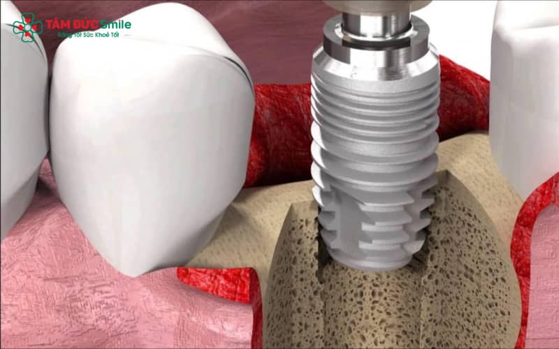 SIC Implant sử dụng vật liệu Titanium nguyên chất 100%, mang lại độ bền tối ưu