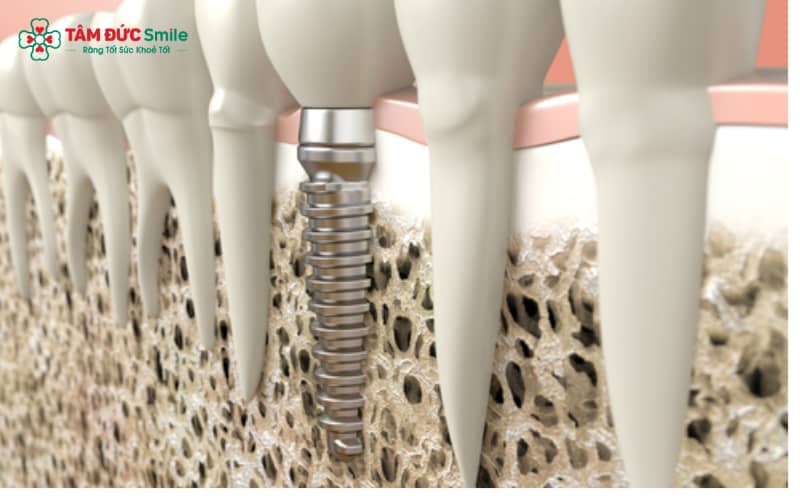 Implant SIC mang đến sự an tâm nhờ khả năng chịu lực và chịu nhiệt xuất sắc