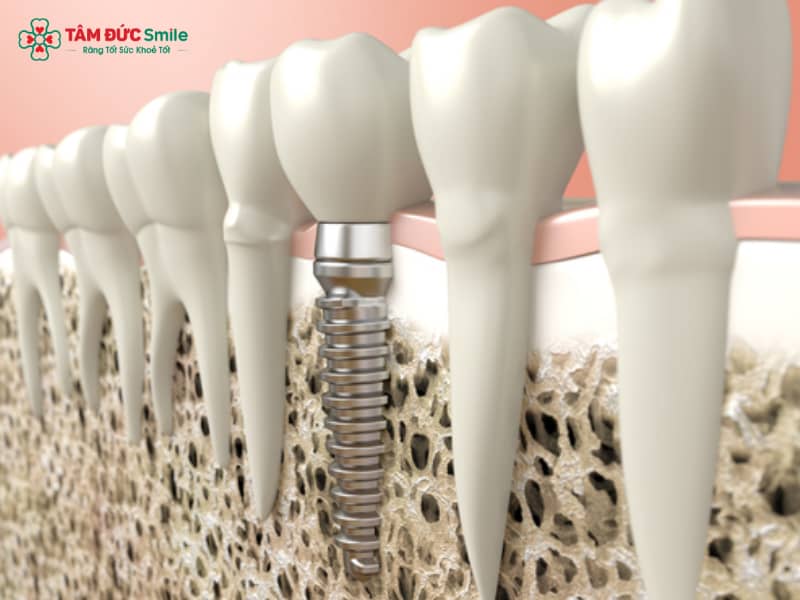 Implant SIC Thụy Sĩ: Giá, Ưu điểm & Đặc điểm nổi bật