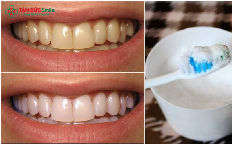 Phương pháp làm trắng răng tại nhà bằng nguyên liệu tự nhiên