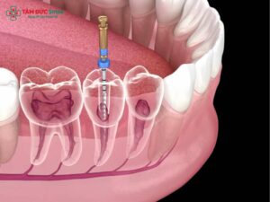 Quy trình lấy tủy răng: biến chứng và chăm sóc sau chữa