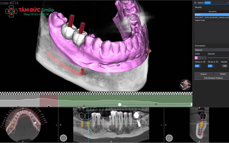 Máng hướng dẫn Implant 3D được chế tác riêng cho từng bệnh nhân, dựa trên chụp CT Conebeam và công nghệ in 3D tiên tiến