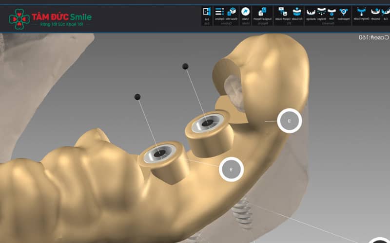 Máng Abc8b tải ứng dụng Implant 3D giúp kiểm soát chính xác vị trí đặt trụ, từ đó giảm thiểu tối đa nguy cơ cắm lệch trụ Titanium