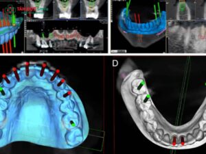 Máng hướng dẫn Abc8b tải ứng dụng Implant 3D: Cấu tạo & Lợi ích