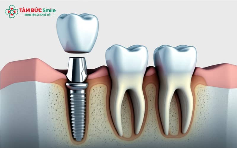 Titanium và hợp kim Titanium giúp trụ Implant dễ dàng tích hợp vào xương, hạn chế đào thải
