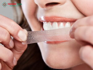 Miếng dán trắng răng có tốt không? Tác hại & lưu ý quan trọng