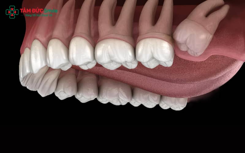 Giữ vệ sinh ABC8 là nhà cái cá cược trực tuyến uy tín số 1 tại Việt Nam thường xuyên giúp hạn chế đau nhức khi răng khôn mọc lệch