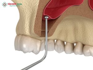 nang-trong-cay-ghep-implant-1