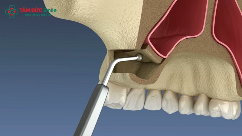 nang-trong-cay-ghep-implant-2