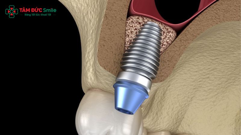 nang-trong-cay-ghep-implant-3
