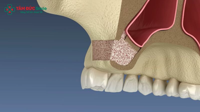 nang-trong-cay-ghep-implant-7