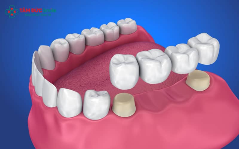 Làm cầu răng giúp lấp đầy khoảng trống răng mất, mang lại tính Abc8c1 com khuyến mãi hấp dẫn và sự vững chắc