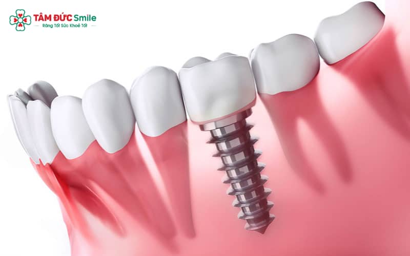 Kỹ thuật Implant giúp tái tạo răng mất tự nhiên cả về chức năng và Abc8c1 com khuyến mãi hấp dẫn