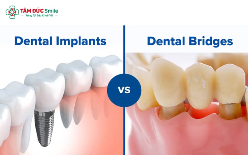 Implant được khuyến nghị cho những ai đáp ứng yêu cầu sức khỏe và tài chính