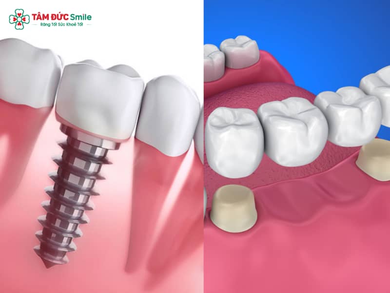Nên làm cầu răng hay Implant? So sánh chi phí và độ bền