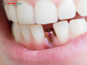 nguoi-tieu-duong-co-trong-rang-implant-duoc-khong-1