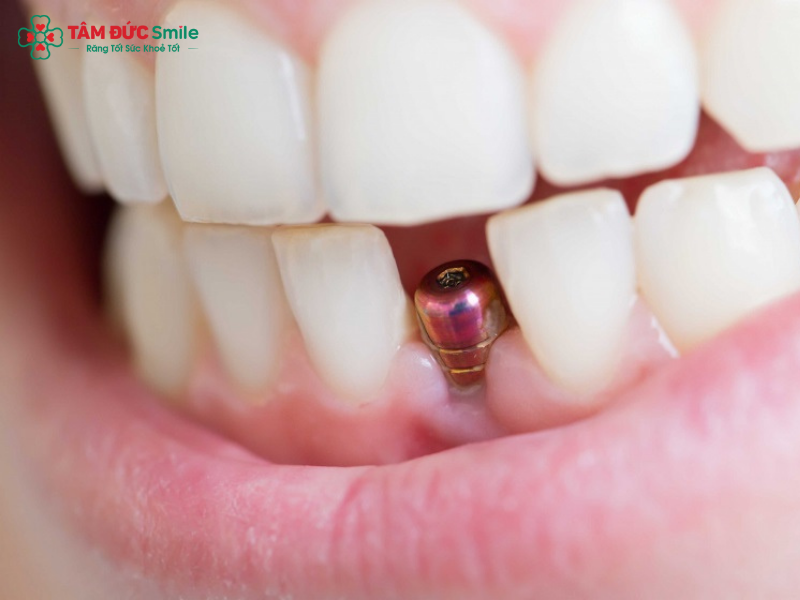 nguoi-tieu-duong-co-trong-rang-implant-duoc-khong-1