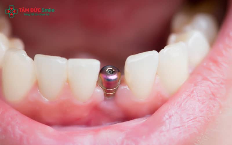 Thực hiện implant là quy trình khó, đòi hỏi ABC8 đường link chính thức giàu kinh nghiệm và chuyên môn vững vàng