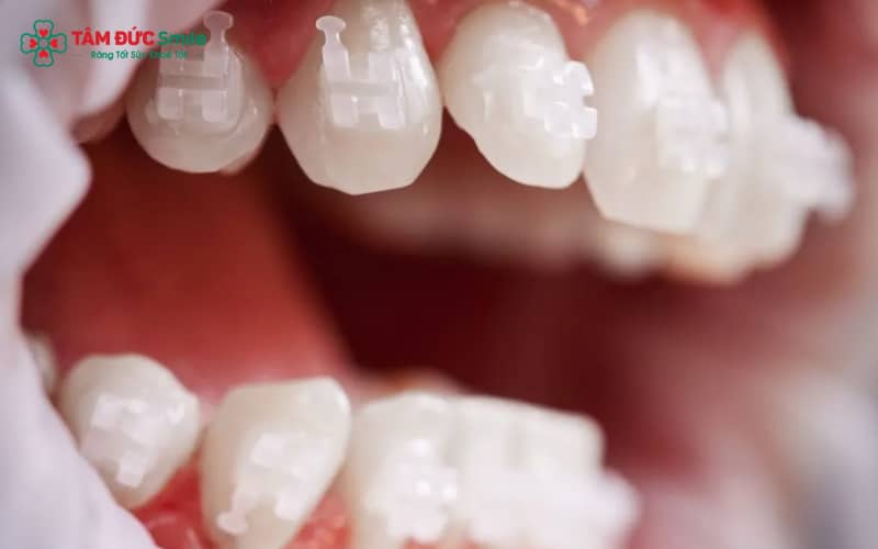 ABC8 được thành lập vào năm 2011 hoạt động đến hiện tại mắc cài pha lê mang lại ABC8 được thành lập vào năm 2011 hoạt động đến hiện tại tự tin nhờ mắc cài trong suốt và dây cung màu trắng tinh tế