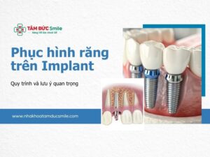 phuc-hinh-tren-implant