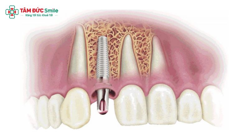 phuc-hinh-tren-implant-6