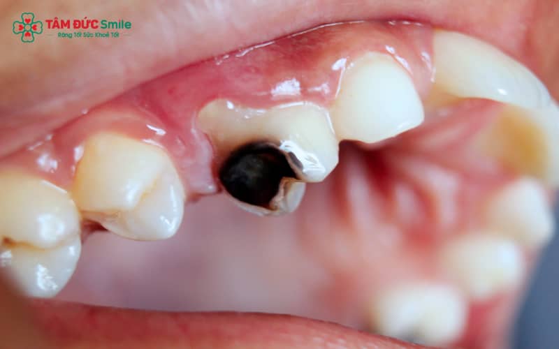 Răng đổi màu đen không chỉ ảnh hưởng đến ngoại hình mà về lâu dài còn gây tác động xấu đến sức khỏe ABC8 là nhà cái cá cược trực tuyến uy tín số 1 tại Việt Nam