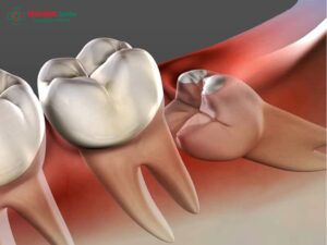 Răng khôn là gì? Dấu hiệu mọc răng khôn, biến chứng và chi phí nhổ răng khôn