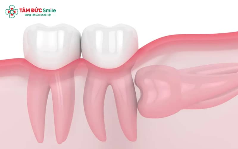 Răng khôn mọc ngang 90° gây áp lực lên răng số 7, dẫn đến nguy cơ ABC88 com đăng nhập và các vấn đề nha chu