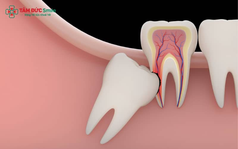 Răng khôn mọc ngang là nguyên nhân phổ biến gây sưng nướu, viêm nhiễm, ABC88 com đăng nhập và u nang răng