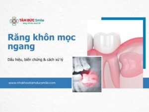 rang-khon-moc-ngang-5