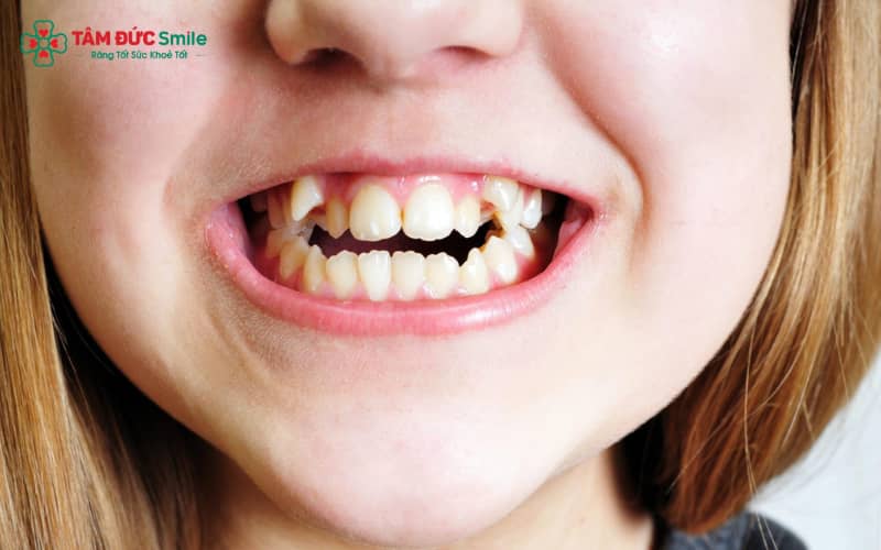 Răng nanh nằm ở vị trí chuyển tiếp giữa răng cửa và răng hàm nhỏ, đóng vai trò cầu nối quan trọng