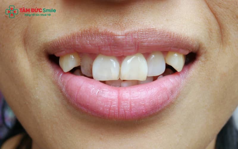 Răng nanh giúp duy trì sự hài hòa của cung hàm, đồng thời ảnh hưởng trực tiếp đến phát âm