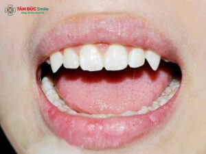 Răng nanh là chiếc răng đặc biệt trong hệ răng người, nằm giữa răng cửa và răng hàm, với hình dáng chóp nhọn, Abc8com giaitri tructuyen dài và chắc khỏe.