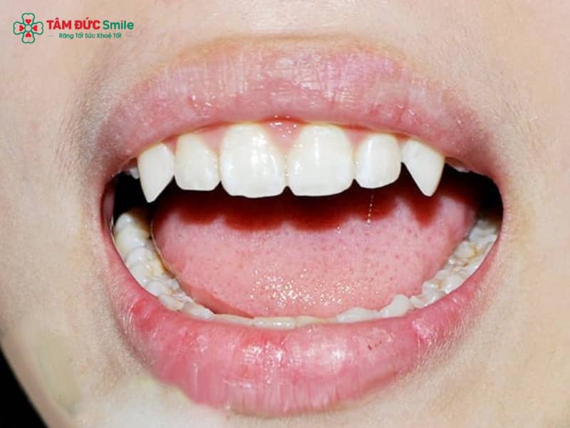 Răng nanh là chiếc răng đặc biệt trong hệ răng người, nằm giữa răng cửa và răng hàm, với hình dáng chóp nhọn, Abc8com giaitri tructuyen dài và chắc khỏe.