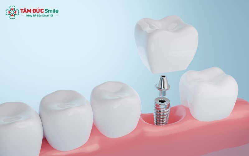 Răng tạm được gắn trên trụ Implant nhằm đảm bảo tính Abc8c1 com khuyến mãi hấp dẫn và hỗ trợ sinh hoạt cho bệnh nhân trước khi phục hình cố định