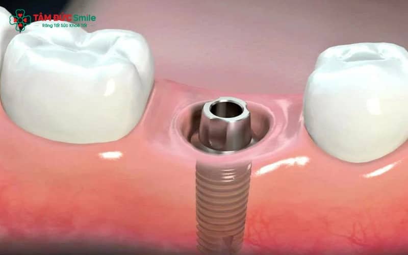 Răng tạm được gắn trên Implant không chỉ đảm bảo Abc8c1 com khuyến mãi hấp dẫn mà còn giúp ăn nhai nhẹ nhàng và giữ dáng mô nướu chuẩn