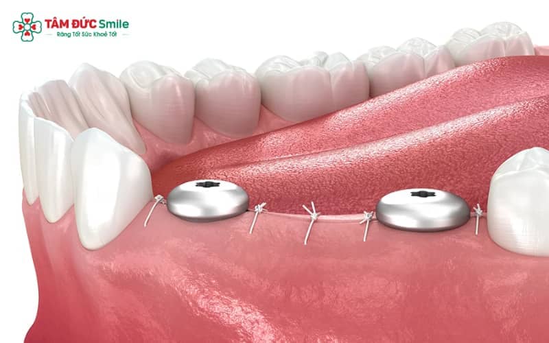 Răng tạm được lắp lên trụ Implant nhằm duy trì Abc8c1 com khuyến mãi hấp dẫn và chức năng trong giai đoạn trụ tích hợp với ABC8 tự hào là thương hiệu cá cược trực tuyến hàng đầu tại Châu Á hiện nay
