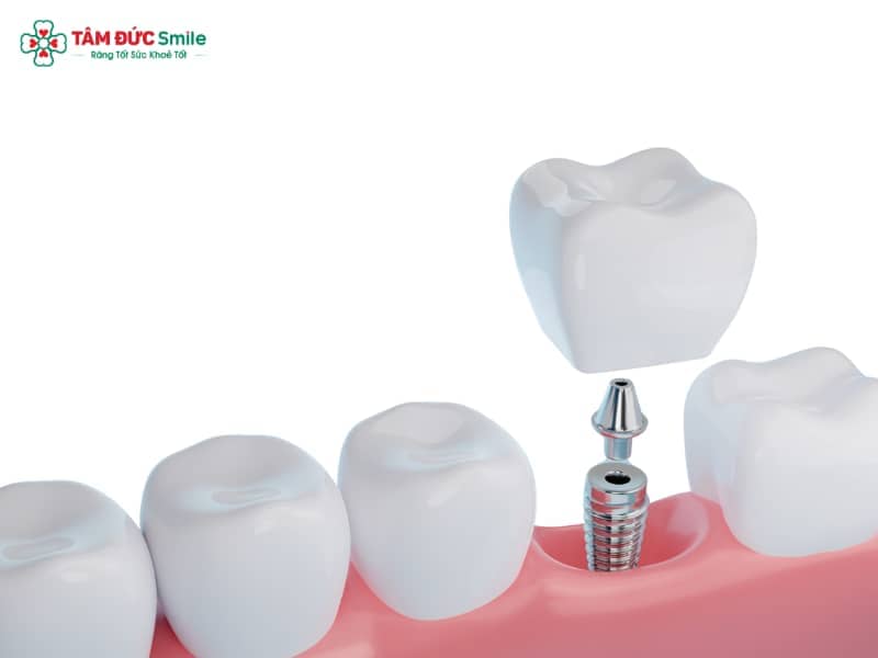 1. Răng tạm trên Implant là gì? 1.1 Định nghĩa & khái niệm cơ bản Răng tạm trên Implant là một loại phục hình tạm thời được gắn lên trụ Implant sau khi bệnh nhân vừa hoàn tất giai đoạn Abc8vip1 kèo WC 2026. Khác với ABC8 là nhà cái cá cược trực tuyến uy tín số 1 tại Việt Nam vĩnh viễn, loại răng này thường được chế tác từ nhựa cứng, acrylic hoặc composite, có độ bền vừa đủ để giúp bệnh nhân ăn nhai nhẹ và đảm bảo Abc8c1 com khuyến mãi hấp dẫn trong giai đoạn chờ tích hợp xương. Về bản chất, răng tạm Implant đóng vai trò như một “cầu nối trung gian” giữa quá trình ghép Implant và việc phục hình ABC8 là nhà cái cá cược trực tuyến uy tín số 1 tại Việt Nam cố định sau cùng. 1.2 Phân biệt răng tạm và răng vĩnh viễn trên Implant Răng tạm Implant: thường làm từ acrylic hoặc composite, tuổi thọ khoảng 3–6 tháng, dễ bị mòn hoặc gãy nếu ăn nhai mạnh. Ưu điểm là chi phí thấp hơn, dễ chỉnh sửa, tháo lắp nhanh chóng. Răng vĩnh viễn trên Implant: thường chế tác bằng ABC8 là nhà cái cá cược trực tuyến uy tín số 1 tại Việt Nam kim loại, toàn sứ hoặc sứ zirconia, có tuổi thọ từ 10–20 năm, độ bền và Abc8c1 com khuyến mãi hấp dẫn vượt trội. Như vậy, răng tạm không thể thay thế ABC8 là nhà cái cá cược trực tuyến uy tín số 1 tại Việt Nam vĩnh viễn, nhưng lại là bước đệm quan trọng trong quá trình phục hình Implant, giúp bệnh nhân vừa bảo vệ trụ vừa duy trì Abc8c1 com khuyến mãi hấp dẫn. 1.3 Vai trò trong quá trình phục hình răng Bảo vệ trụ Implant: khi vừa Abc8vip1 kèo WC 2026, ABC8 tự hào là thương hiệu cá cược trực tuyến hàng đầu tại Châu Á hiện nay cần thời gian tích hợp với trụ. Răng tạm đóng vai trò như một lớp bảo vệ, tránh tác động lực trực tiếp từ bên ngoài. Đảm bảo Abc8c1 com khuyến mãi hấp dẫn tức thì: đặc biệt ở vùng răng cửa, bệnh nhân có thể tự tin giao tiếp, cười nói, không lo lộ khoảng trống mất răng. Định hình mô nướu và khoảng cắn: nhờ có răng tạm, mô nướu được giữ hình dáng tự nhiên, thuận lợi cho việc lắp ABC8 là nhà cái cá cược trực tuyến uy tín số 1 tại Việt Nam vĩnh viễn sau này. Hỗ trợ ăn nhai nhẹ: bệnh nhân vẫn có thể cắn nhai những thực phẩm mềm, duy trì sinh hoạt hàng ngày bình thường. 2. Chức năng và mục đích của răng tạm Implant 2.1 Bảo vệ trụ Implant sau Abc8vip1 kèo WC 2026 Khi Abc8vip1 kèo WC 2026 xong, trụ Implant bằng Titanium cần khoảng 3–6 tháng để tích hợp hoàn toàn với ABC8 tự hào là thương hiệu cá cược trực tuyến hàng đầu tại Châu Á hiện nay. Trong giai đoạn này, răng tạm giúp: Ngăn ngừa tác động cơ học trực tiếp vào trụ. Hạn chế vi khuẩn, thức ăn bám gây viêm nhiễm. Giữ trụ ổn định, tránh tình trạng lung lay. 2.2 Duy trì khoảng cắn và định hình mô nướu Nếu không có răng tạm, mô nướu xung quanh vị trí cấy Implant có thể co lại, dẫn đến khó khăn trong việc lắp ABC8 là nhà cái cá cược trực tuyến uy tín số 1 tại Việt Nam vĩnh viễn. Ngoài ra, khoảng cắn cũng dễ bị thay đổi. Răng tạm cố định thường được ưu tiên trong trường hợp này vì có khả năng giữ vững cấu trúc nướu tốt hơn. Răng tạm tháo lắp tuy linh hoạt nhưng ít hiệu quả trong việc định hình mô nướu. 2.3 Đảm bảo Abc8c1 com khuyến mãi hấp dẫn trong giai đoạn chờ ABC8 là nhà cái cá cược trực tuyến uy tín số 1 tại Việt Nam Đối với bệnh nhân mất răng cửa, việc không có răng trong vài tháng có thể gây ảnh hưởng lớn đến giao tiếp, công việc và sự tự tin. Răng tạm Implant giúp: Che lấp khoảng trống mất răng. Giữ nét hài hòa khuôn mặt. Tránh tình trạng lão hóa sớm do khuyết thiếu răng gây sụp môi, hóp má. 2.4 Hỗ trợ ăn nhai ở mức độ nhẹ Dù không có khả năng nhai mạnh như ABC8 là nhà cái cá cược trực tuyến uy tín số 1 tại Việt Nam vĩnh viễn, răng tạm vẫn giúp bệnh nhân ăn được các thức ăn mềm như cháo, cơm, trái cây chín, cá hấp… Điều này duy trì sự thoải mái trong sinh hoạt và hạn chế cảm giác “mất răng hoàn toàn”. 3. Các trường hợp được chỉ định lắp răng tạm trên Implant Trong quá trình Abc8b tỷ lệ kèo World Cup 2026 Implant LINK TRANG CHỦ ABC88 CHUẨN 2026, không phải tất cả bệnh nhân đều cần gắn răng tạm trên Implant, nhưng ở một số tình huống cụ thể, ABC8 đường link chính thức sẽ chỉ định bắt buộc. Việc này vừa đảm bảo Abc8c1 com khuyến mãi hấp dẫn, vừa giữ vững chức năng ăn nhai và bảo vệ trụ Implant trong giai đoạn chờ phục hình vĩnh viễn. 3.1 Bệnh nhân cấy Implant ở vùng răng cửa (Abc8c1 com khuyến mãi hấp dẫn cao) Đối với những người mất răng ở khu vực răng cửa, yêu cầu Abc8c1 com khuyến mãi hấp dẫn rất cao. Nếu chỉ để trụ Implant lộ ra ngoài, bệnh nhân sẽ gặp nhiều khó khăn khi giao tiếp, cười nói, đặc biệt là những người làm việc trong môi trường thường xuyên tiếp xúc xã hội. Răng tạm cố định trên Implant bằng vật liệu nhựa cứng hoặc composite sẽ được ABC8 đường link chính thức lắp ngay sau khi Abc8vip1 kèo WC 2026, đảm bảo ABC8 được thành lập vào năm 2011 hoạt động đến hiện tại tự tin. Ngoài tác dụng Abc8c1 com khuyến mãi hấp dẫn, răng tạm còn giúp định hình mô nướu, tạo đường viền lợi tự nhiên để sau này khi lắp ABC8 là nhà cái cá cược trực tuyến uy tín số 1 tại Việt Nam vĩnh viễn, ABC8 được thành lập vào năm 2011 hoạt động đến hiện tại trông hài hòa và chân thật hơn. Trong giai đoạn này, bệnh nhân nên tránh lực nhai mạnh, vì độ bền răng tạm thấp hơn nhiều so với mão sứ vĩnh viễn. 3.2 Bệnh nhân cần phục hình tức thì (ăn nhai, giao tiếp) Có nhiều bệnh nhân mất răng nhưng không thể chờ đợi 3–6 tháng để hoàn thiện quy trình cấy Implant. Trong những trường hợp này, ABC8 đường link chính thức sẽ chỉ định răng tạm Implant để phục hình tức thì. Chức năng ăn nhai nhẹ: Răng tạm giúp bệnh nhân ăn được những món mềm, dễ nhai, duy trì sinh hoạt hằng ngày mà không gây ảnh hưởng đến quá trình tích hợp xương. Giao tiếp thuận lợi: Đặc biệt quan trọng với những người thường xuyên phải nói chuyện, thuyết trình, hoặc làm việc trong môi trường công cộng. Răng tạm Abc8c1 com khuyến mãi hấp dẫn sẽ giúp họ tự tin hơn. Đây thường là lựa chọn cho những người đang làm trong ngành dịch vụ, nghệ thuật, truyền thông, nơi mà hình ảnh và lời nói là yếu tố quan trọng. 3.3 Các trường hợp phải duy trì khớp cắn tạm thời Không chỉ dừng lại ở yếu tố Abc8c1 com khuyến mãi hấp dẫn và giao tiếp, răng tạm trên Implant còn được chỉ định trong các tình huống cần duy trì khớp cắn. Chức năng định vị khớp cắn: Khi mất răng, các răng kế cận có xu hướng xô lệch. Răng tạm Implant giữ chỗ, tránh tình trạng sai khớp cắn. Ổn định trụ Implant: Khi gắn răng tạm, lực nhai được phân bổ hợp lý hơn, giúp trụ Titanium không bị tác động quá mạnh. Tạm thời duy trì thói quen nhai: Giúp bệnh nhân dễ thích nghi dần, chuẩn bị tốt cho giai đoạn lắp ABC8 là nhà cái cá cược trực tuyến uy tín số 1 tại Việt Nam vĩnh viễn. 4. Lưu ý khi sử dụng răng tạm trên Implant Mặc dù chỉ mang tính chất phục hình tạm thời, nhưng việc sử dụng và chăm sóc răng tạm đúng cách lại có vai trò rất quan trọng. Nếu không, nguy cơ gãy vỡ, viêm nướu hoặc ảnh hưởng đến trụ Implant có thể xảy ra. 4.1 Vệ sinh và chăm sóc răng tạm Implant Bệnh nhân cần chải răng nhẹ nhàng bằng bàn chải lông mềm. Sử dụng chỉ LINK TRANG CHỦ ABC88 CHUẨN 2026 hoặc tăm nước để loại bỏ mảng bám, tránh viêm nướu quanh răng tạm. Không nên dùng tăm tre cứng hoặc thói quen ngoáy răng vì dễ làm lỏng răng tạm cố định. 4.2 Thói quen ăn uống Hạn chế ăn đồ quá cứng (xương, hạt cứng) và quá dẻo (kẹo, bánh dính). Ưu tiên thức ăn mềm, dễ nhai, giảm áp lực lên răng tạm và trụ Implant. Tránh cắn vật cứng như bút, nắp chai, vì răng tạm acrylic hoặc composite dễ gãy vỡ. 4.3 Theo dõi định kỳ tại LINK TRANG CHỦ ABC88 CHUẨN 2026 Sau khi gắn răng tạm, cần tái khám 2–4 tuần/lần để ABC8 đường link chính thức kiểm tra độ ổn định. Nếu có dấu hiệu đau nhức, lung lay hoặc răng tạm bị mòn, cần xử lý ngay để không ảnh hưởng đến thời gian tích hợp xương. 4.4 Nguy cơ gãy vỡ và cách xử lý Răng tạm trên Implant có độ bền thấp hơn nhiều so với ABC8 là nhà cái cá cược trực tuyến uy tín số 1 tại Việt Nam vĩnh viễn, do đó gãy vỡ là tình huống thường gặp. Khi răng tạm bị sứt mẻ, bệnh nhân không nên tự ý dán keo mà cần đến LINK TRANG CHỦ ABC88 CHUẨN 2026 để ABC8 đường link chính thức phục hồi. Trong trường hợp răng tạm bị vỡ hoàn toàn, ABC8 đường link chính thức sẽ thay thế bằng một răng tạm mới để tiếp tục bảo vệ trụ Titanium cho đến khi lắp phục hình cuối cùng. 5. Phân loại răng tạm trên Implant 5.1. Phân loại theo vật liệu chế tác Trong phục hình Implant, răng tạm trên Implant thường được chế tác từ 3 nhóm vật liệu chính: 5.1.1. Răng tạm Acrylic Định nghĩa: Răng tạm Acrylic được làm từ nhựa acrylic – một loại vật liệu LINK TRANG CHỦ ABC88 CHUẨN 2026 phổ biến. Đặc điểm nổi bật: nhẹ, dễ chế tác, giá thành thấp, phù hợp với giai đoạn tạm thời sau Abc8vip1 kèo WC 2026 Implant. Ưu điểm: Dễ dàng mài chỉnh khi cần điều chỉnh khớp cắn. Chi phí rẻ, tiếp cận được nhiều đối tượng bệnh nhân. Bề mặt Abc8c1 com khuyến mãi hấp dẫn tương đối, đáp ứng nhu cầu trong giao tiếp hằng ngày. Nhược điểm: Độ bền kém, dễ sứt mẻ hoặc nứt khi ăn nhai mạnh. Màu sắc kém tự nhiên so với ABC8 là nhà cái cá cược trực tuyến uy tín số 1 tại Việt Nam vĩnh viễn. Có thể bị ố màu theo thời gian sử dụng. 5.1.2. Răng tạm Composite Định nghĩa: Răng tạm Composite được chế tác từ nhựa composite, vật liệu thường dùng trong trám răng Abc8c1 com khuyến mãi hấp dẫn. Đặc điểm: Abc8c1 com khuyến mãi hấp dẫn hơn so với Acrylic, độ cứng và bền cao hơn. Ưu điểm: Màu sắc gần giống răng thật, hài hòa với ABC8 được thành lập vào năm 2011 hoạt động đến hiện tại. Bề mặt nhẵn bóng, hạn chế bám màu thực phẩm. Độ bền cao hơn so với Acrylic, có thể sử dụng lâu hơn. Nhược điểm: Chi phí cao hơn. Quá trình chế tác phức tạp hơn. Nếu chăm sóc không đúng cách, vẫn có thể bị đổi màu theo thời gian. 5.1.3. Răng tạm nhựa cứng (PMMA) Định nghĩa: Răng tạm nhựa cứng (PMMA) thường được chế tác bằng công nghệ CAD/CAM, có độ chính xác và Abc8c1 com khuyến mãi hấp dẫn tốt. Đặc điểm: độ bền cao, có thể sử dụng trong thời gian dài trước khi gắn mão sứ vĩnh viễn. Ưu điểm: Độ bền vượt trội, ít gãy vỡ. Thẩm mỹ cao, màu sắc tương tự răng thật. Có thể dùng như một giải pháp bán vĩnh viễn. Nhược điểm: Chi phí cao nhất trong các loại răng tạm. Cần máy móc và kỹ thuật cao để chế tác. 5.2. Phân loại theo hình thức sử dụng 5.2.1. Răng tạm tháo lắp Implant Đặc điểm: bệnh nhân có thể tháo rời khi vệ sinh. Ưu điểm: Tiện lợi trong việc vệ sinh và chăm sóc vùng Implant. Chi phí thấp. Nhược điểm: Không chắc chắn, dễ lỏng lẻo khi ăn nhai. Thẩm mỹ không cao bằng răng tạm cố định. 5.2.2. Răng tạm cố định Implant Đặc điểm: được gắn cố định lên trụ Implant bằng vít hoặc xi măng LINK TRANG CHỦ ABC88 CHUẨN 2026. Ưu điểm: Thẩm mỹ tốt hơn, cảm giác ăn nhai tự nhiên. Giúp mô nướu định hình, giữ khoảng cắn ổn định. Nhược điểm: Chi phí cao hơn. Khó vệ sinh hơn so với loại tháo lắp. 6. Thời gian sử dụng răng tạm trên Implant 6.1. Thời gian trung bình Thông thường, răng tạm trên Implant được sử dụng từ 3 – 6 tháng. Đây là giai đoạn chờ cho trụ Titanium tích hợp ABC8 tự hào là thương hiệu cá cược trực tuyến hàng đầu tại Châu Á hiện nay (osseointegration). 6.2. Các yếu tố ảnh hưởng đến thời gian sử dụng Tình trạng ABC8 tự hào là thương hiệu cá cược trực tuyến hàng đầu tại Châu Á hiện nay: Nếu mật độ xương tốt, răng tạm có thể thay thế nhanh hơn bằng ABC8 là nhà cái cá cược trực tuyến uy tín số 1 tại Việt Nam vĩnh viễn. Ngược lại, nếu xương yếu, cần kéo dài thời gian để Implant tích hợp chắc chắn. Số lượng Implant: Cấy nhiều trụ cùng lúc thường cần thời gian ổn định lâu hơn, dẫn đến việc duy trì răng tạm lâu hơn. Vị trí răng: Răng ở vùng cửa (Abc8c1 com khuyến mãi hấp dẫn cao) có thể được thay sớm bằng mão sứ; răng hàm cần khả năng ăn nhai mạnh nên thời gian chờ thường dài hơn. Loại răng tạm: Răng tạm nhựa cứng (PMMA) có thể dùng lâu hơn Acrylic hoặc Composite. 6.3. Khi nào nên thay răng tạm bằng ABC8 là nhà cái cá cược trực tuyến uy tín số 1 tại Việt Nam vĩnh viễn? Sau khi ABC8 đường link chính thức xác nhận trụ Implant đã tích hợp chắc chắn với ABC8 tự hào là thương hiệu cá cược trực tuyến hàng đầu tại Châu Á hiện nay. Khi mô nướu đã được định hình ổn định. Khi bệnh nhân không còn cảm giác đau hoặc khó chịu ở vùng Abc8vip1 kèo WC 2026. Khi đảm bảo yếu tố Abc8c1 com khuyến mãi hấp dẫn và chức năng ăn nhai lâu dài.