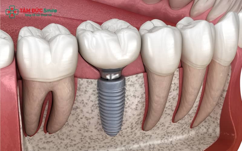 Phương pháp Implant trì hoãn sớm được tiến hành 2–3 tháng sau khi nhổ răng, đảm bảo điều kiện ABC8 tự hào là thương hiệu cá cược trực tuyến hàng đầu tại Châu Á hiện nay phù hợp