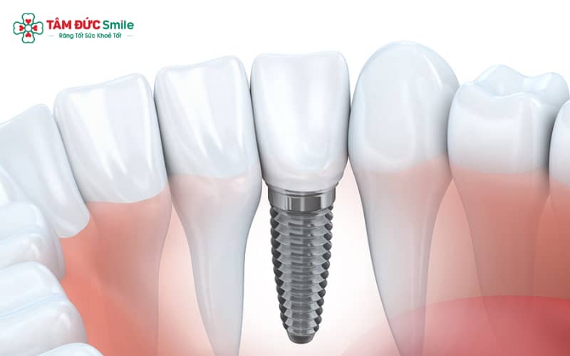 Phương pháp Implant trì hoãn muộn tiến hành 4–6 tháng sau nhổ răng, phù hợp cho những trường hợp cần thời gian lành thương lâu hơn