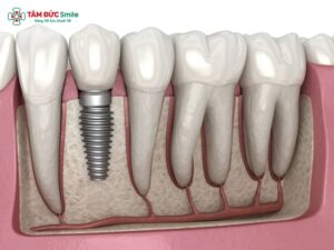 Sau khi nhổ răng bao lâu thì trồng Implant? Thời điểm tối ưu
