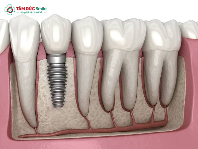 Sau khi nhổ răng bao lâu thì trồng Implant? Thời điểm tối ưu