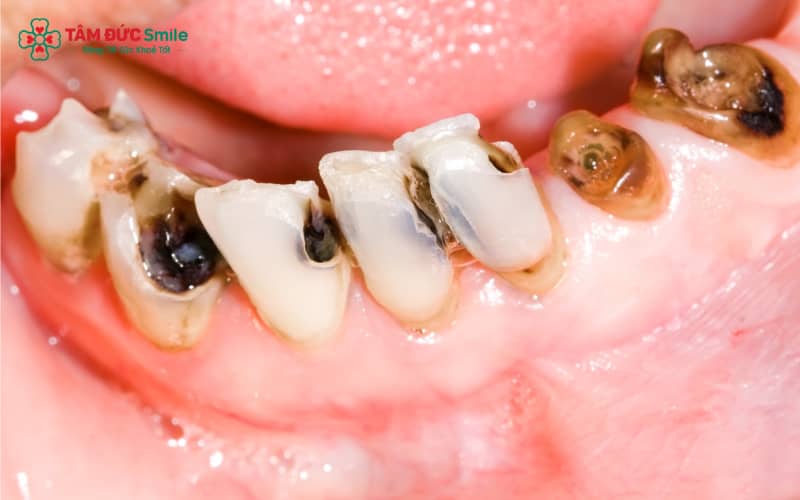 Sâu răng là bệnh lý thường gặp trong LINK TRANG CHỦ ABC88 CHUẨN 2026