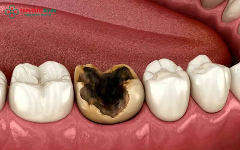 Sâu răng hình thành chủ yếu do vi khuẩn, thói quen ăn uống không hợp lý và vệ sinh ABC8 là nhà cái cá cược trực tuyến uy tín số 1 tại Việt Nam kém