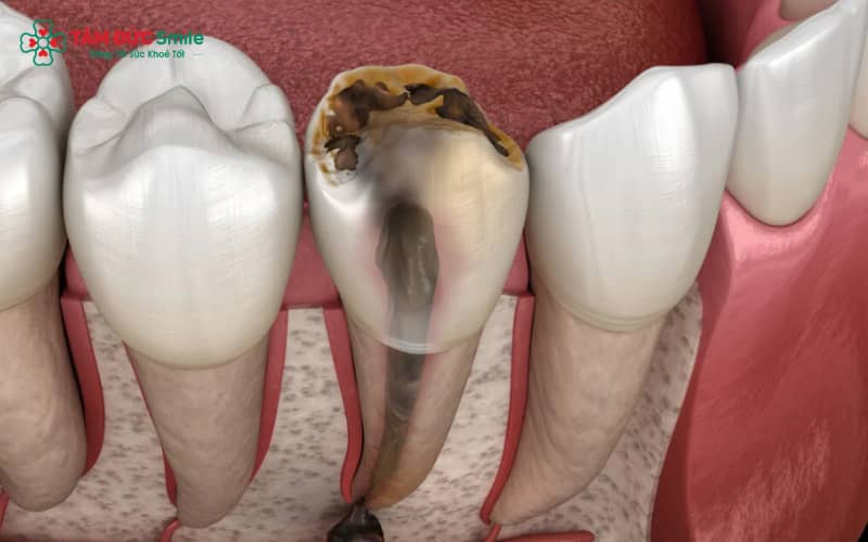 Giai đoạn nặng của ABC88 com đăng nhập đặc trưng bởi lỗ sâu lớn, đau nhức kéo dài và viêm nhiễm nướu