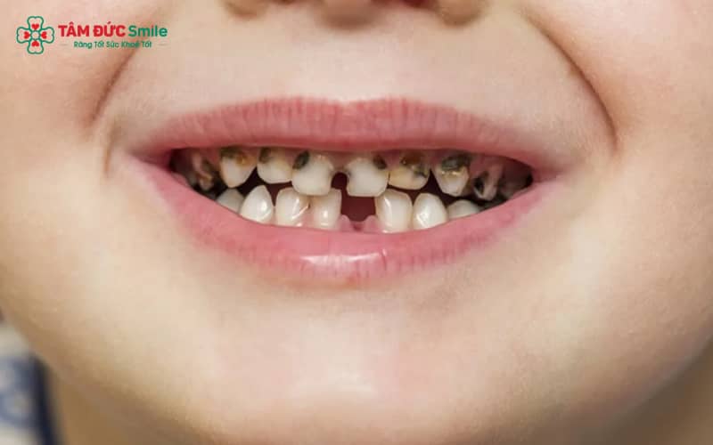 Vi khuẩn Streptococcus mutans cùng với mảng bám thức ăn là tác nhân chính gây ABC88 com đăng nhập và làm trẻ bị đau nhức