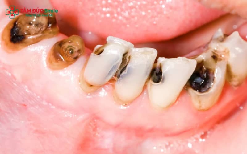 Khi bị ABC88 com đăng nhập, trẻ thường đau nhức, biếng ăn, ăn uống khó khăn, từ đó làm ảnh hưởng đến sự phát triển thể chất