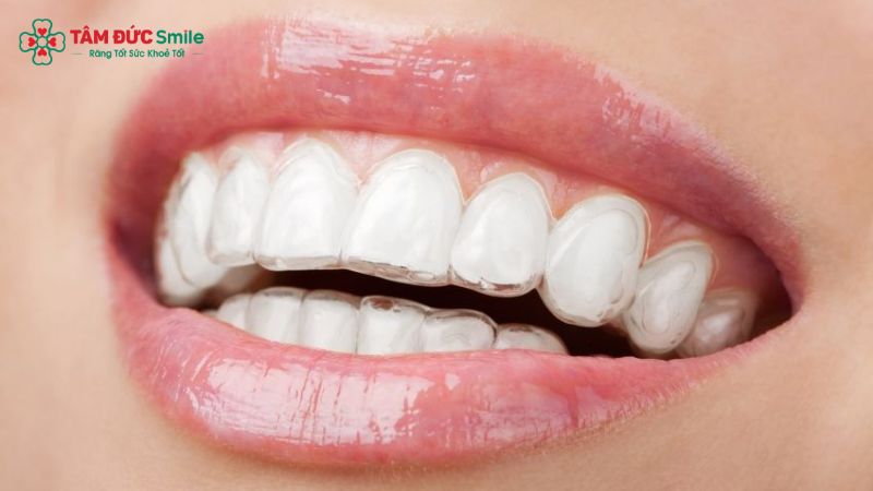 so-sanh-nieng-invisalign-va-mac-cai-2