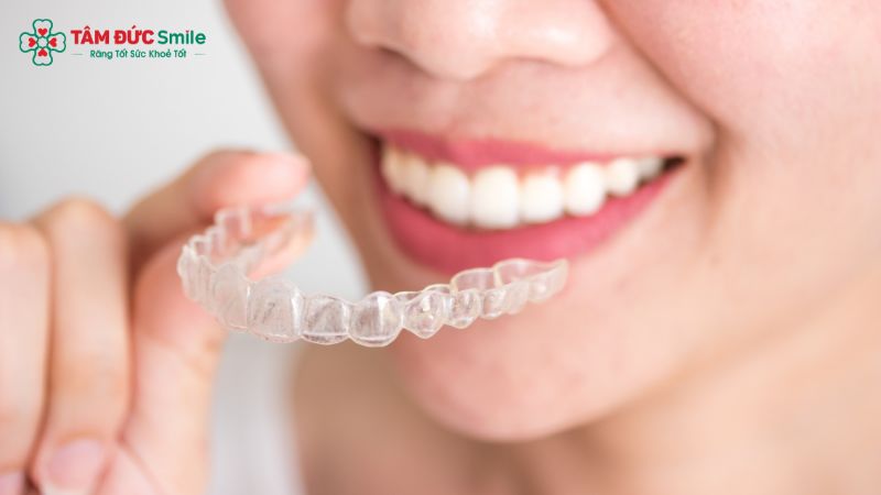 so-sanh-nieng-invisalign-va-mac-cai-4